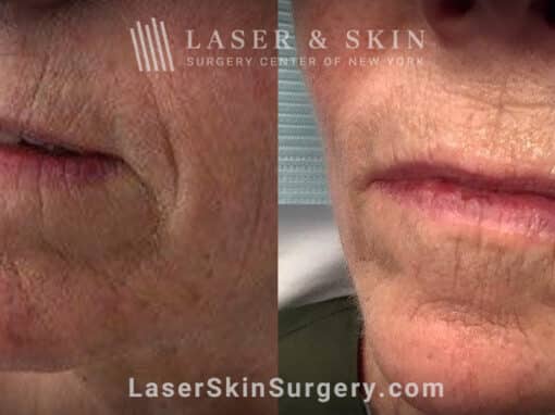 Genius microneedling to smooth perioral lines around the mouth