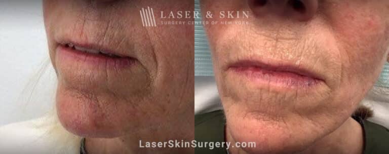 Genius microneedling to smooth perioral lines around the mouth