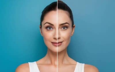 Dysport vs. Botox: Which is Right For You?