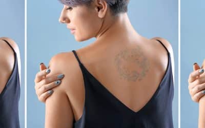 Laser Tattoo Removal: What It Is, How It Works, and What to Expect