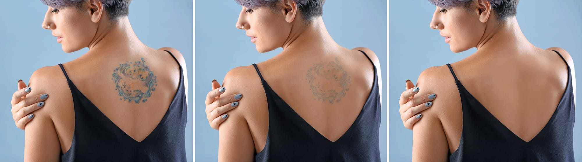 laser-tattoo-removal-what-it-is-how-it-works-and-what-to-expect tattoo removal new york