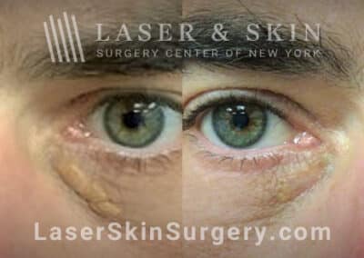 Erbium laser treatments to remove Xanthalasma