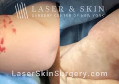 Pulsed dye laser to treat hemangioma on toddler’s arm