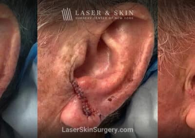 Mohs surgery to remove skin cancer from the ear