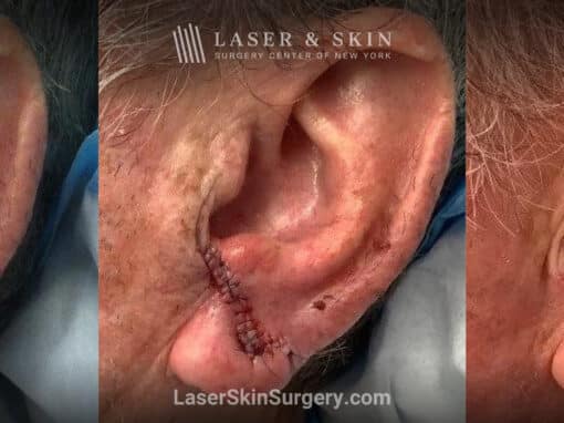 Mohs surgery to remove skin cancer from the ear