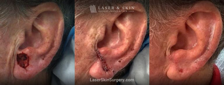 Mohs surgery to remove skin cancer from the ear