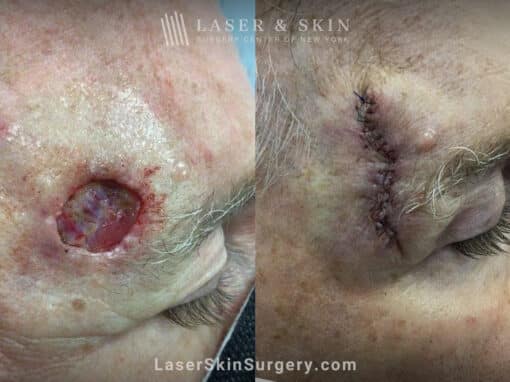 Mohs surgery to remove skin cancer from the forehead