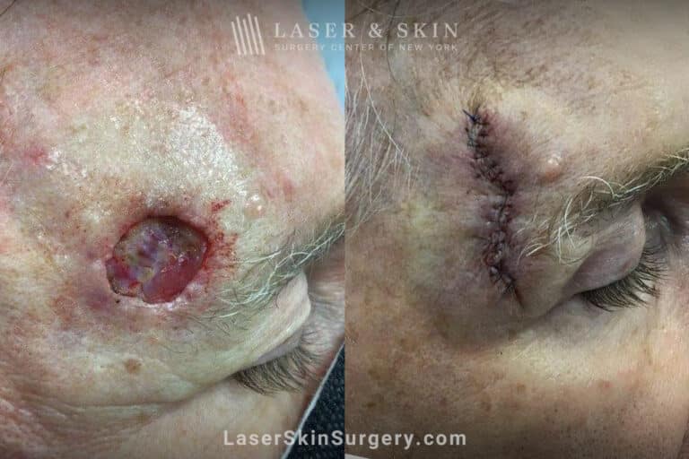 Mohs surgery to remove skin cancer from the forehead