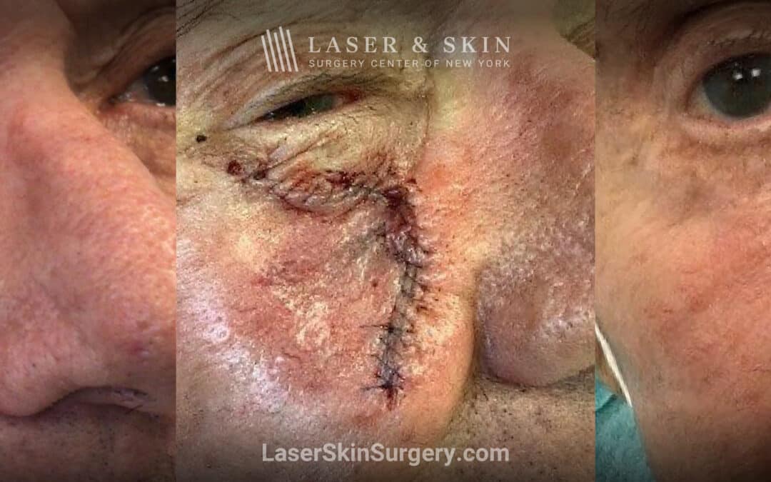 Mohs surgery to remove skin cancer on the cheek near the nose