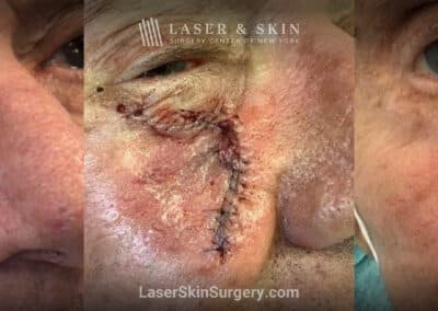 Mohs surgery to remove skin cancer on the cheek near the nose
