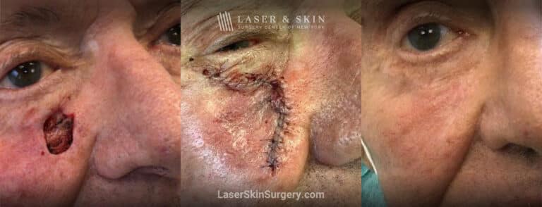 Mohs surgery to remove skin cancer on the cheek near the nose