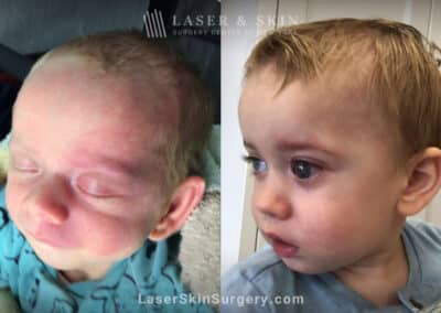 Port wine birthmark treatment with the Vbeam laser