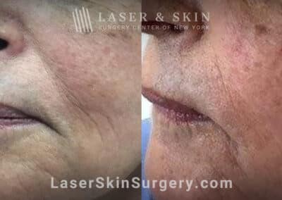 Facial fillers with lattice technique to target fine wrinkles in the lower face