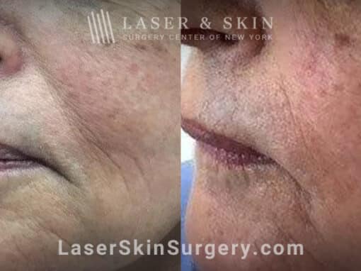 Facial fillers with lattice technique to target fine wrinkles in the lower face