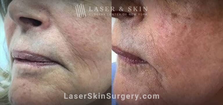 Facial fillers with lattice technique to target fine wrinkles in the lower face