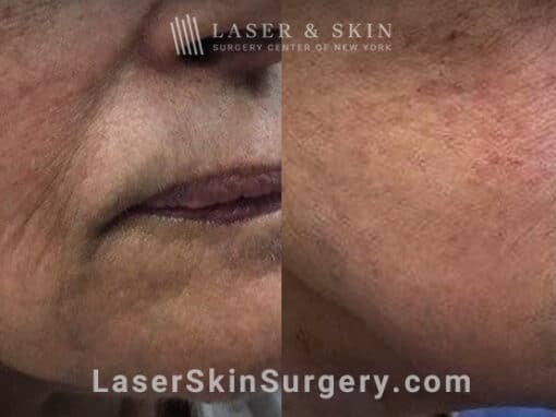 Facial fillers with lattice technique to target fine lines in the lower face