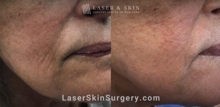 Facial fillers with lattice technique to target fine lines in the lower face