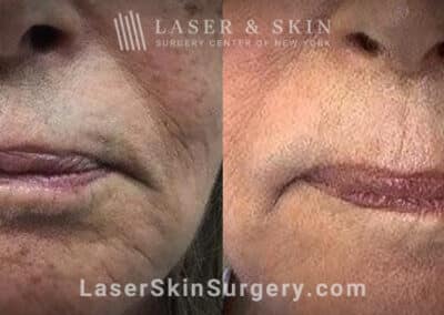 Facial fillers with lattice technique to target fine wrinkles in the lower face