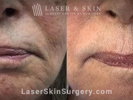 Facial fillers with lattice technique to target fine wrinkles in the lower face