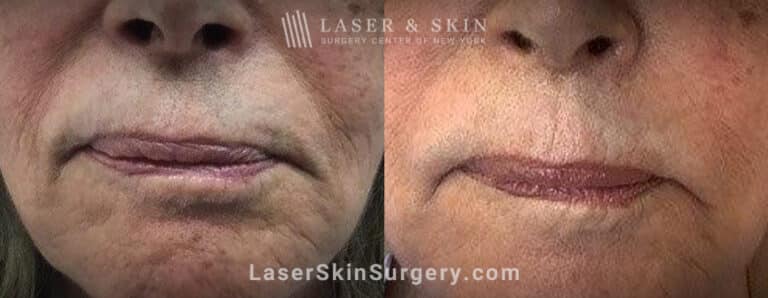 Facial fillers with lattice technique to target fine wrinkles in the lower face