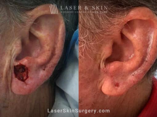 Mohs surgery to remove skin cancer from the ear