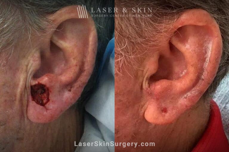 Mohs surgery to remove skin cancer from the ear