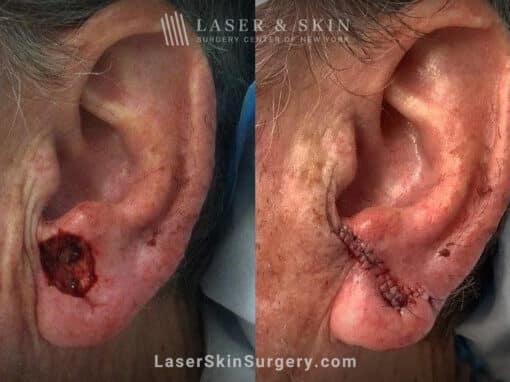 Mohs surgery to remove skin cancer from the ear