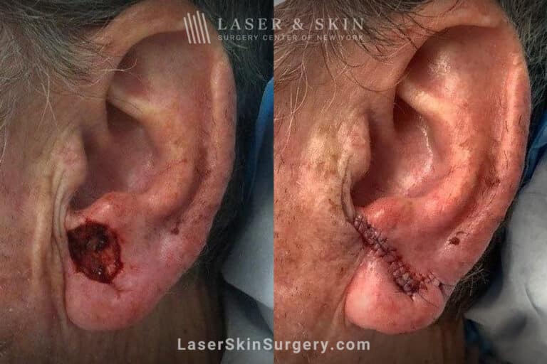 Mohs surgery to remove skin cancer from the ear