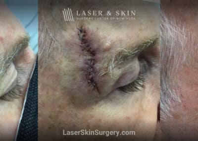 Mohs surgery to remove skin cancer from the forehead
