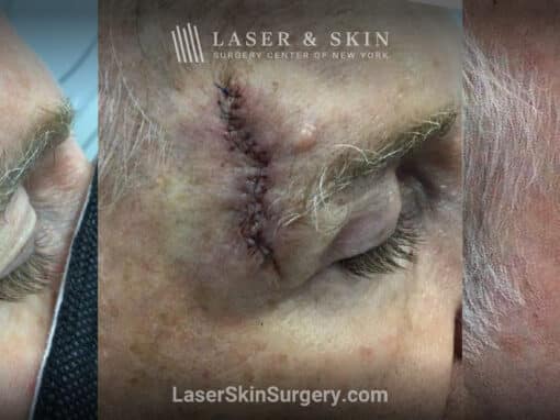 Mohs surgery to remove skin cancer from the forehead