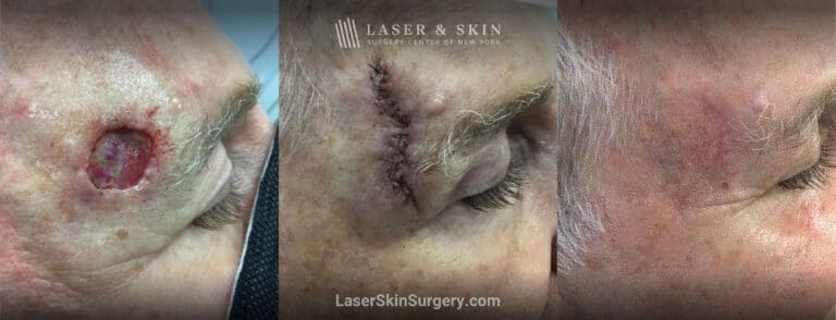 Mohs surgery to remove skin cancer from the forehead