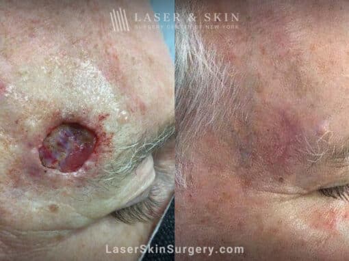 Mohs surgery to remove skin cancer from the forehead