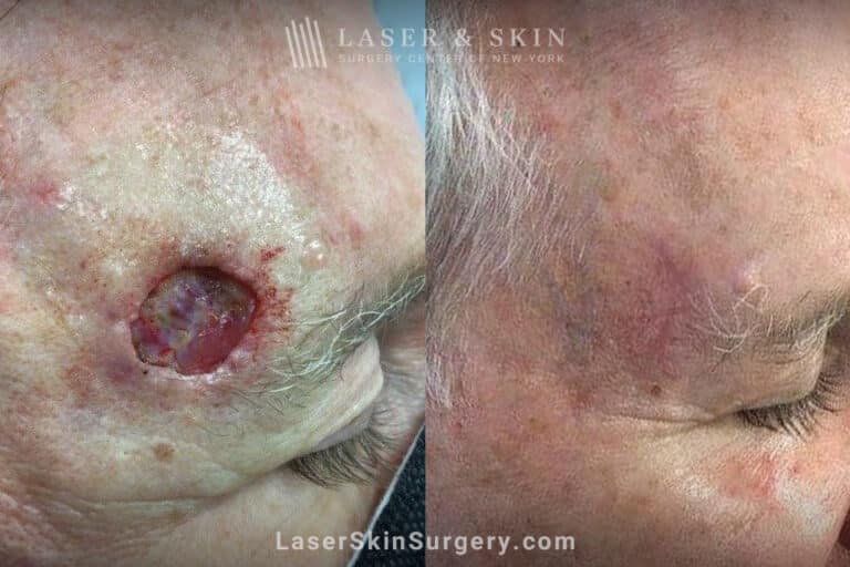 Mohs surgery to remove skin cancer from the forehead