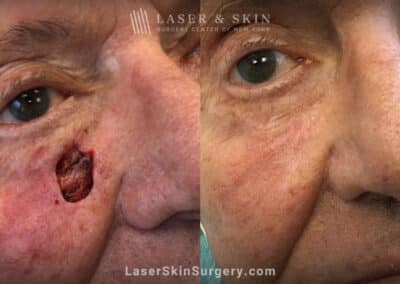 Mohs surgery to remove skin cancer on the cheek near the nose