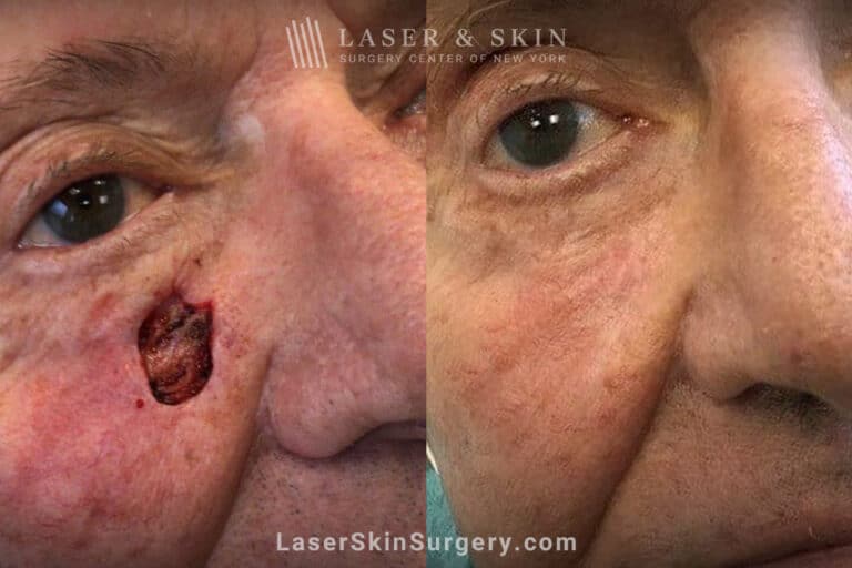 Mohs surgery to remove skin cancer on the cheek near the nose