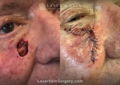 Mohs surgery to remove skin cancer on the cheek near the nose