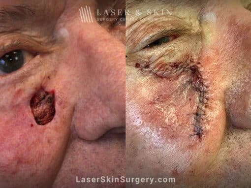 Mohs surgery to remove skin cancer on the cheek near the nose