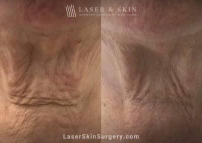 Sofwave and Ultherapy to tight the skin beneath the chin and neck