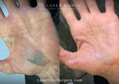 PicoPlus laser treatments to remove traumatic tattoo from hand