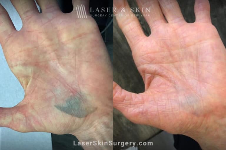 PicoPlus laser treatments to remove traumatic tattoo from hand