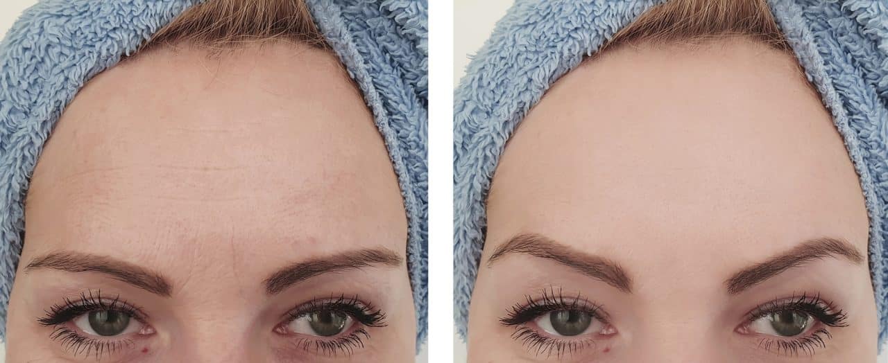 The Science Behind Preventative Botox: How It Works to Keep Wrinkles at ...
