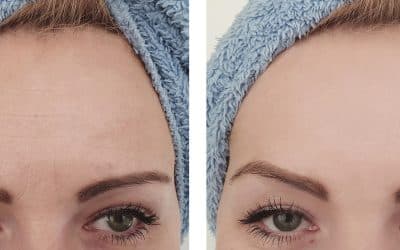 The Science Behind Preventative Botox: How It Works to Keep Wrinkles at Bay