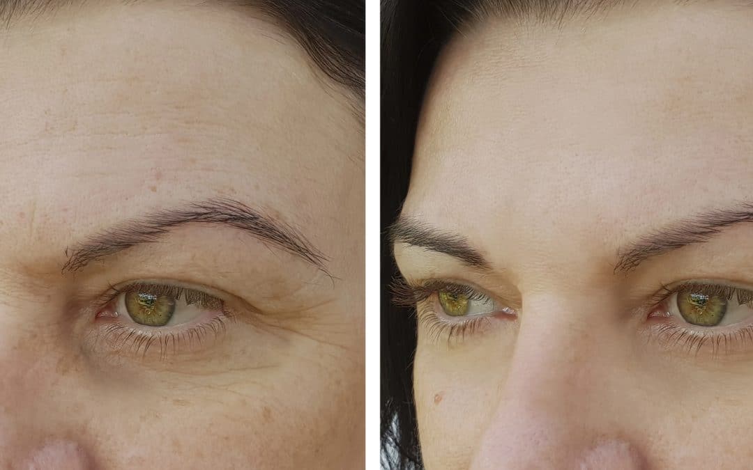 Facial Laser Treatment: What to Expect
