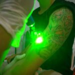 What You Need to Know About Laser Tattoo Removal Before Going Under the Beam