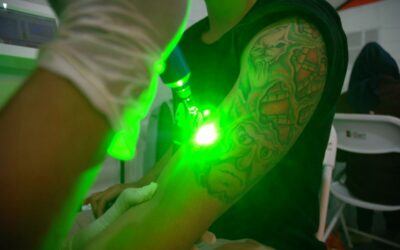 What You Need to Know About Laser Tattoo Removal Before Going Under the Beam