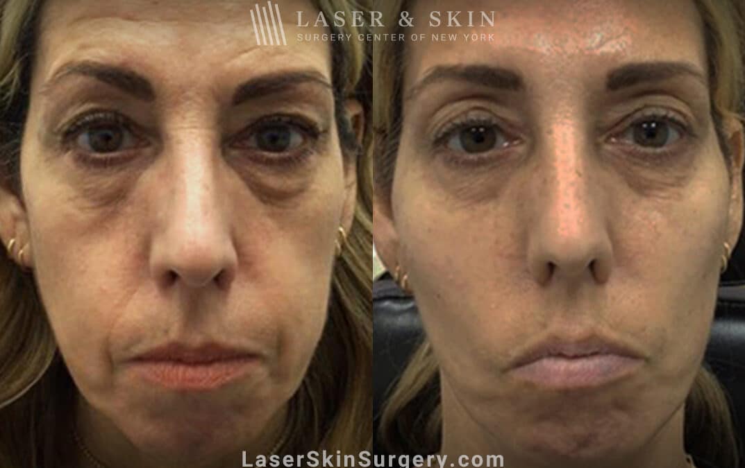 dermal fillers before and after