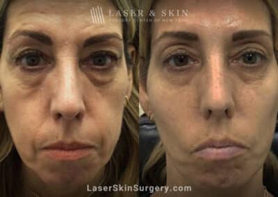 Filler injections for facial rejuvenation