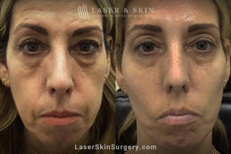 Filler injections for facial rejuvenation