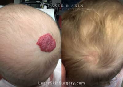 Pulsed dye laser treatments to minimize hemangioma on infant’s scalp