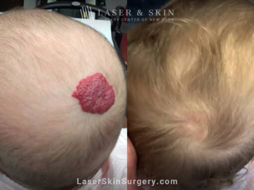 Pulsed dye laser treatments to minimize hemangioma on infant’s scalp